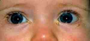 Альбуцид в глаза с какого возраста