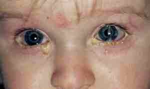 Как применять альбуцид детям в глаза