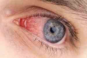 Капли от аллергии для глаз альбуцид