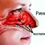 Альбуцид в нос при насморке