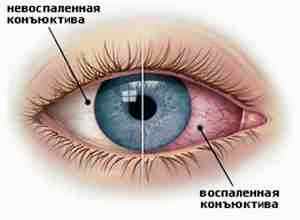 Как часто капать альбуцид при коньюктивите ребенку