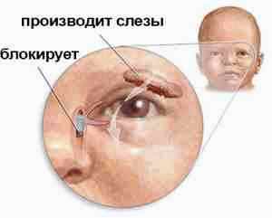 Альбуцид новорожденным при гноящихся глазках