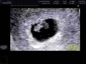 Альбуцид при беременности 1 триместр