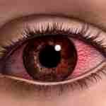 Альбуцид капли глазные от покраснения глаз