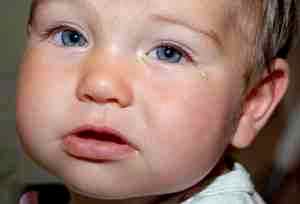 Альбуцид в глаз ребенку 3 месяца