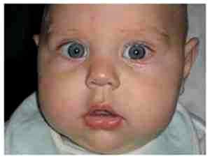 Альбуцид в глаза ребенку 2 месяца