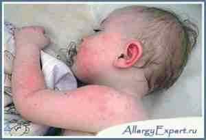 Аллергия на альбуцид у грудничка