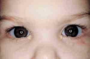 Альбуцид глазные капли ребенку 3 года