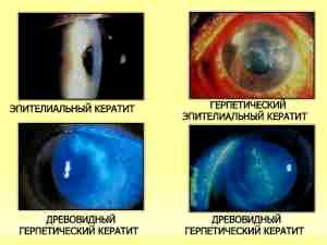 Альбуцид инструкция по применению капли в глаза
