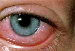 Альбуцид капли глазные при аллергии