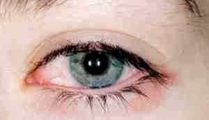 Альбуцид капли глазные при аллергии