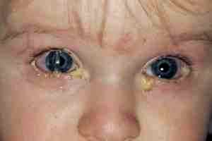 Коньюктивит глаз лечение у детей лечение альбуцид