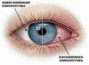 Левомицетин или альбуцид глазные капли цена
