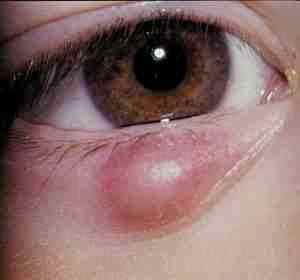 Сколько дней можно капать альбуцид в глаз ребенку