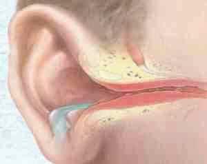 Альбуцид 20 процентов в ухо