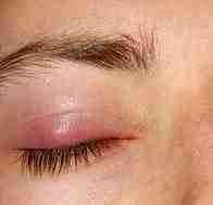Альбуцид глазные капли для детей