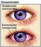 Альбуцид глазные капли для детей