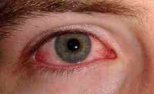 Альбуцид глазные капли инструкция это антибиотик