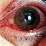 Альбуцид при кровоизлиянии в глаз