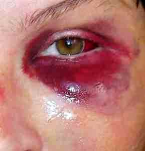 Альбуцид при кровоизлиянии в глаз