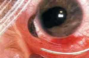 Что такое альбуцид глазные капли