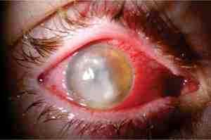 Что такое альбуцид глазные капли