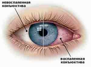 Сульфацил натрия солофарм глазные капли альбуцид