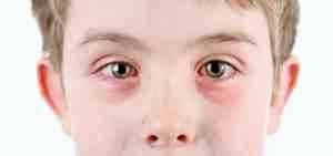 Альбуцид при воспалении глаз ребенку