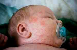 Аллергия на альбуцид у новорожденных