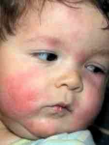 Аллергия на альбуцид у ребенка фото