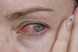 Глазные капли при коньюктивите для детей альбуцид