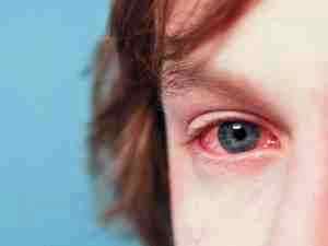 Левомицитиновые глазные капли или альбуцид