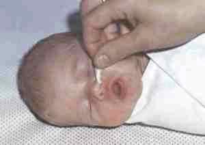 Сколько можно капать альбуцид в глаза новорожденному