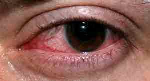 Альбуцид болят глаза от сварки