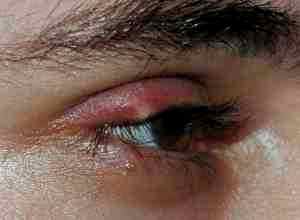 Альбуцид глазные капли для лечения ячменя