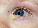 Альбуцид при гное из глаз у детей
