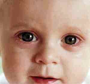 Альбуцид глазные капли дозировка для детей