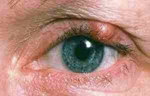 Альбуцид глазные капли дозировка для детей