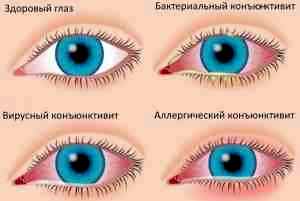 Детские глазные капли от коньюктивита альбуцид