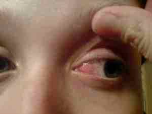 Детские глазные капли от коньюктивита альбуцид