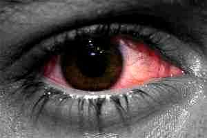 Коньюктивит глаз лечение у детей альбуцид