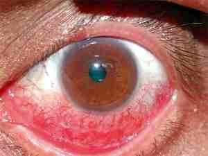Коньюктивит глаз лечение у детей альбуцид