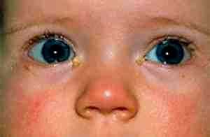 Конъюнктивит у ребенка лечение альбуцидом