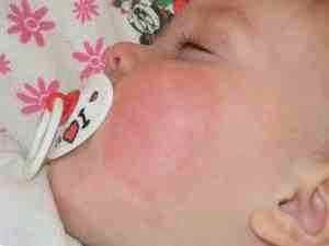 Лечение насморка у новорожденных альбуцид