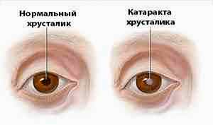 Можно ли при катаракте капать альбуцид