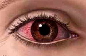 Альбуцид помогает при красных глазах