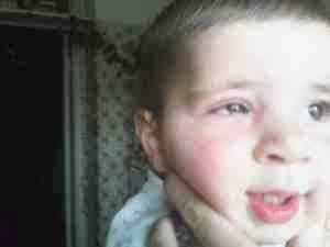 Альбуцид в нос детям сколько раз в день