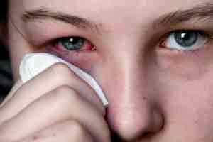 Глазные капли от воспаления глаз альбуцид