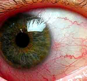 Альбуцид глазные капли для чего назначают