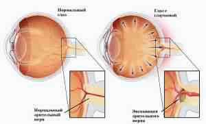 Купить альбуцид глазные капли инструкция по применению
